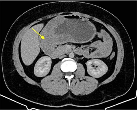 Figure From Smad Juvenile Polyposis Syndrome And Hereditary