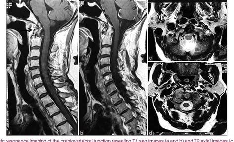 Figure From Unilateral Spontaneous Ankylosis Of The C C Joint With