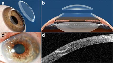 Corneal Surgery In Keratoconus Which Type Which Technique Which