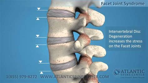 Facet Joint Syndrome: Causes, Symptoms, Treatment, Prevention ...