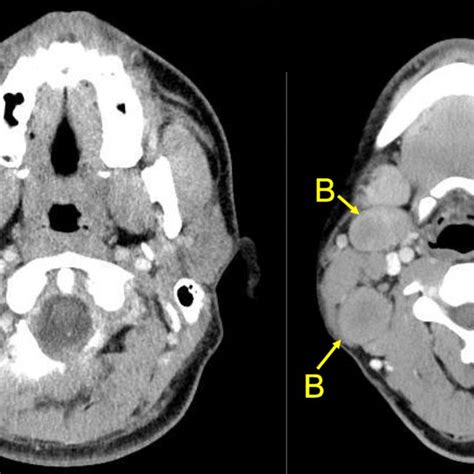 Head Computed Tomography Shows Tumor At Right Parotid Gland A And