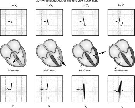 Chamber Abnormalities And Intraventricular Conduction Defects