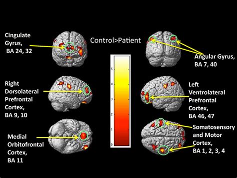 Whole Brain Vbm Analyses Controls Patients The D Color Map Showing