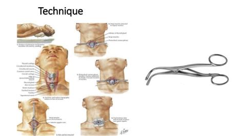 Tracheostomy Steps