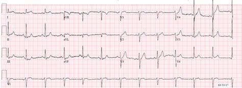 Ekg Practice Flashcards Quizlet