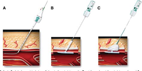 Figure 3 From Femoral Arterial Access And Closure Semantic Scholar