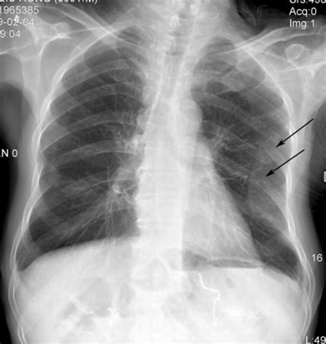 Interpreting A Chest X Ray Stepwards