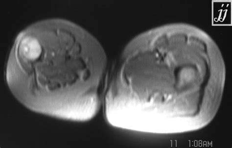 Right Femur Fibrous Dysplasia Radiopaedia