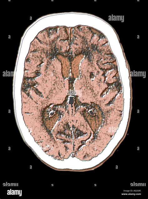 Gammagraf A Cerebral Mostrando Atrofia Cerebral Fotograf A De Stock Alamy