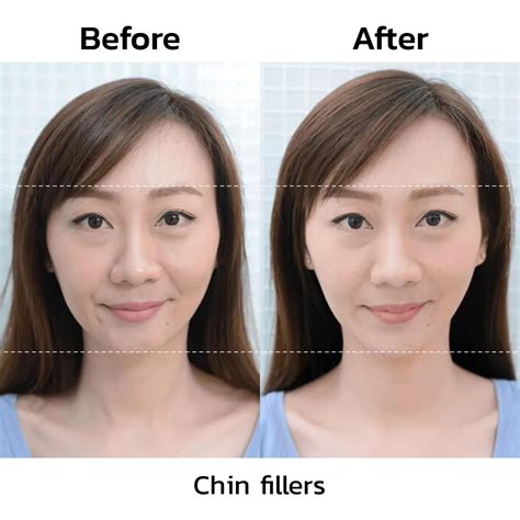 Chin Filler To Solve Short Chin Problems Chin Reduction Adjust The