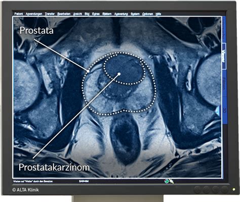 Prostatakarzinom Fr Herkennung Und Therapiem Glichkeiten