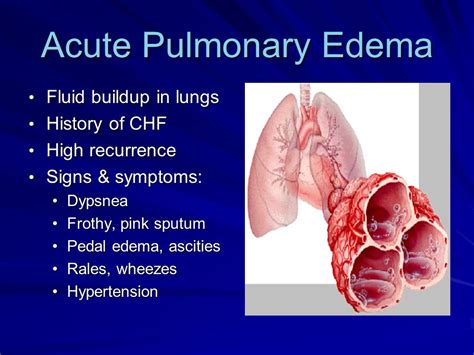 Pulmonary Edema Sputum