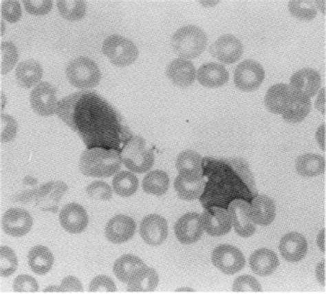 Malignant Histiocytosis In Leukemic Phase Case Report And Review Of