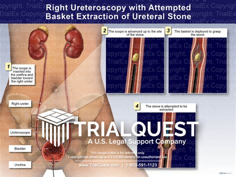 Right Ureterscopy With Attempted Basket Extraction Of Ureteral St