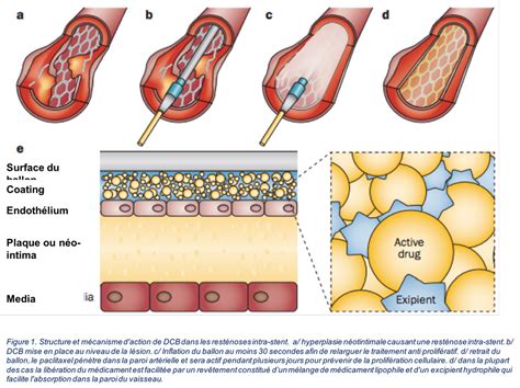 Angioplastie coronarienne intérêt et limites des stents actifs HAS