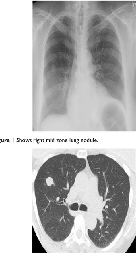 Figure From Sarcoidosis A Rare Cause Of Solitary Pulmonary Nodule