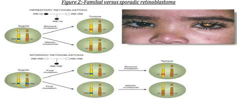 Figure 1 From Retinoblastoma A Molecular Dream Semantic Scholar