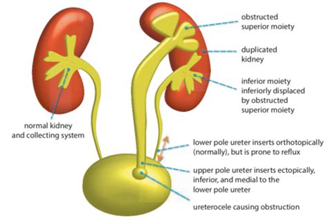 Duplicated Right Renal Collecting System Hideawaytips