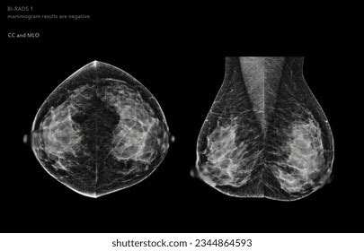 180 Mammogram Results Images, Stock Photos, and Vectors | Shutterstock