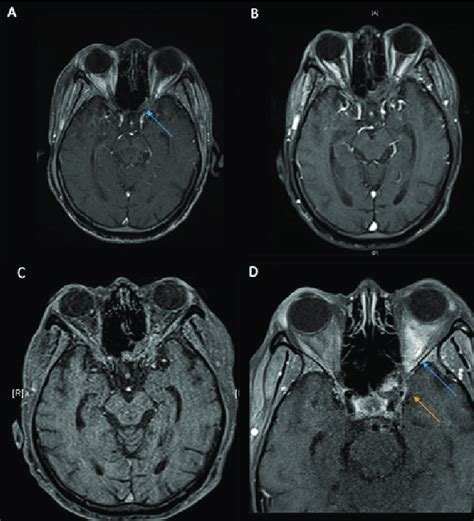 MRI Brain Images Showing Progression Of Orbital Apex Involvement A