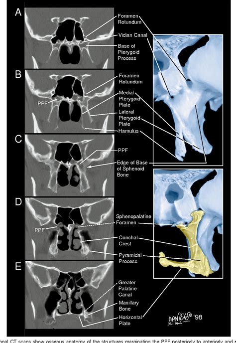 Pterygopalatine Fossa Ct Anatomy