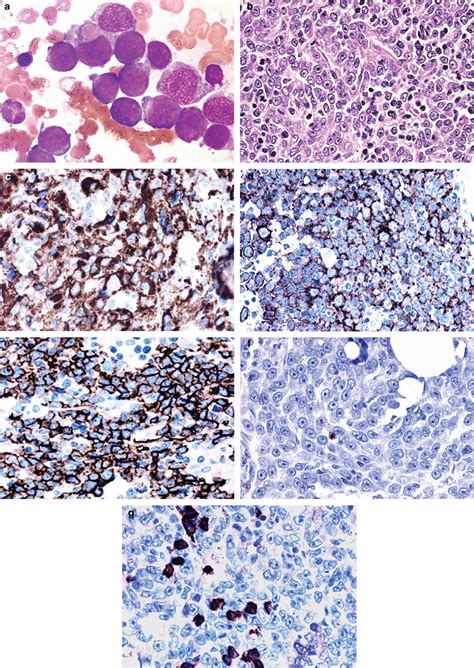 Acute Panmyelosis With Myelofibrosis An Entity Distinct From Acute