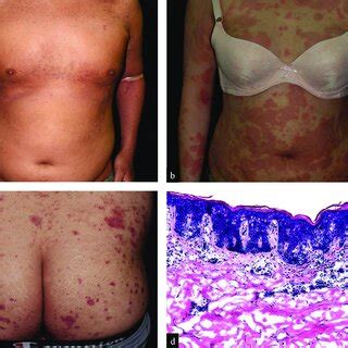 A C Representative Clinical Images Of Asian Patients With Ad Which