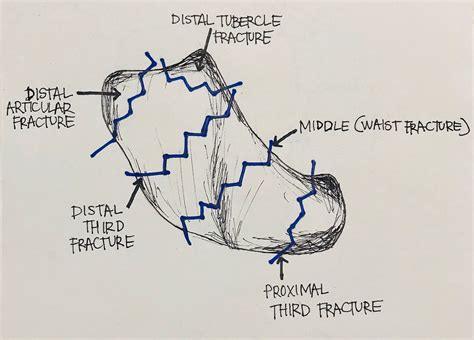 Scaphoid Tubercle And Waist Fracture