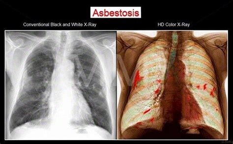 What Is Asbestosis Mesothelioma Law Firm Mesothelioma Basic Facts