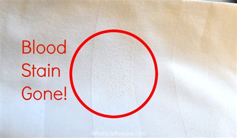 How To Remove Dried Set In Blood Stains From Clothes