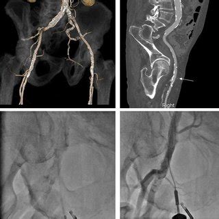 Computed Tomography Fluoroscopy And Femoral Angiography For Femoral