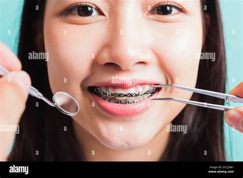 Asian Teen Beautiful Young Woman Smile Have Dental Braces On Teeth Laughing And Have Medical