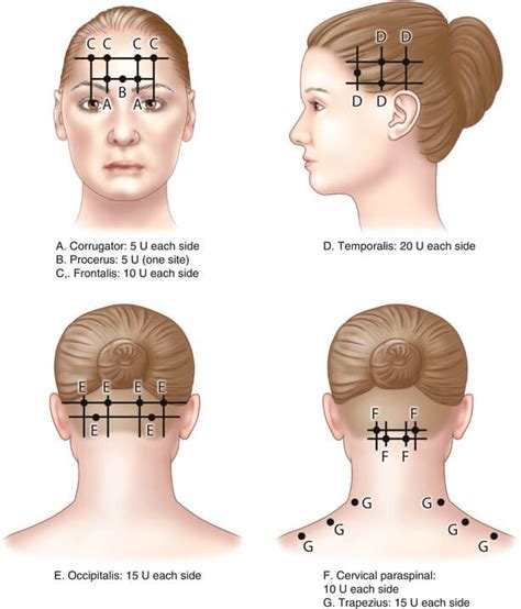 Botox For Migraine Who Is It For What Does It Do What Does It Feel Like East Neurology