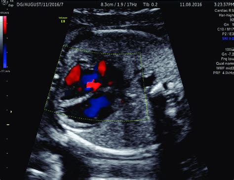 The Aparent Normal 4 Chamber View Section On Color Doppler Imaging