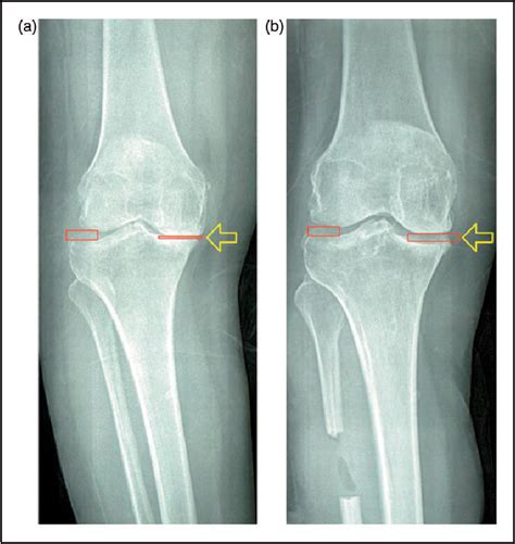 Proximal Fibular Osteotomy A New Surgery For Pain Relief And