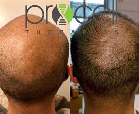 Procell Microchanneling For Hair Growth Merton Mezquita