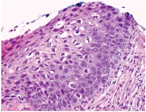 High Grade Lesion In Cervix High Grade Squamous Intraepithelial Lesion Hsil Causes