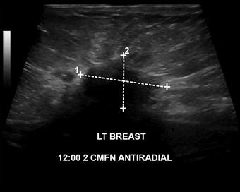 Breast Cancer Diagnosed By Stress Spect Sestamibi The Role Of Inverse