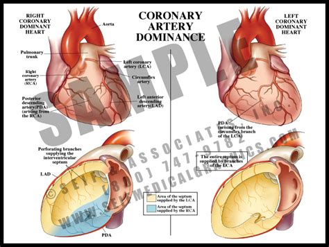 Coronary Artery Anatomy Sanda Medical Graphics