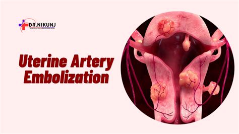 Uterine Artery Embolization