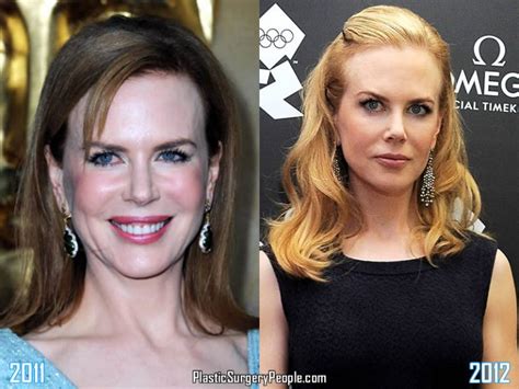 Did Nicole Kidman Have Facelift & Lip Augmentation?