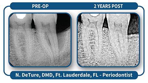 Lanap® Laser Treatment Millennium Dental Technologies Inc