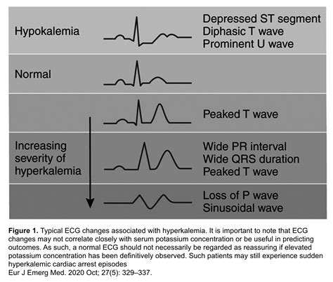 Hyperkalemia Ekg