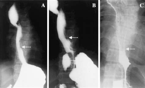 Case 2. A. Initial esophagram at 14 days of age showed a tapered ...