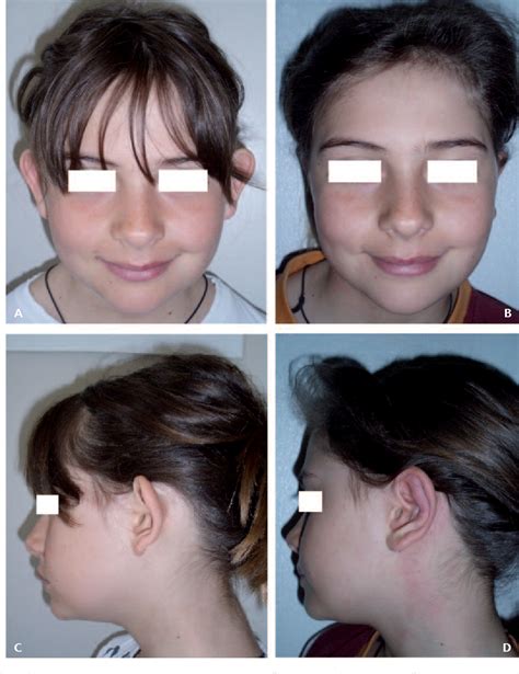 Figure 4 From Otoplasty For Prominent Ears Deformity Semantic Scholar