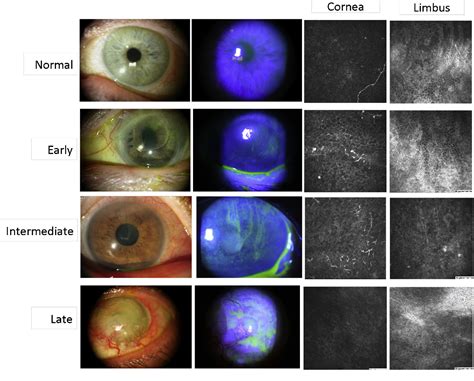 Figure 1 From Epithelial Thinning In Limbal Stem Cell Deficiency