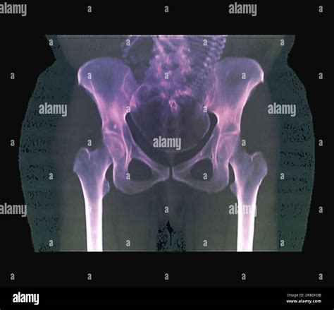 Coloured Computed Tomography Ct Scan Of The Pelvis Of A 41 Year Old Female Patient Who Is 32