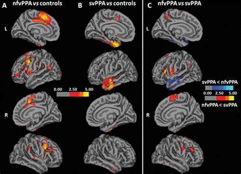 Differentiation Between Subtypes Of Primary Progressive Aphasia By