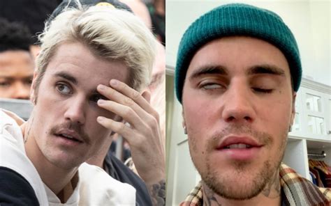 Justin Bieber sufre el síndrome de Ramsay Hunt En qué consiste y