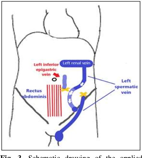 Figure 1 From Inguinal Microscopic Varicocelectomy With Spermatic Vein